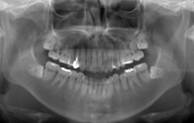 歯周炎と診断