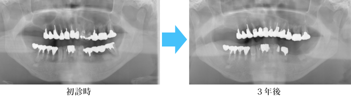 歯周外科治療の術前術後