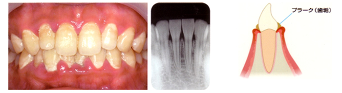 歯肉炎〜軽度の歯周炎